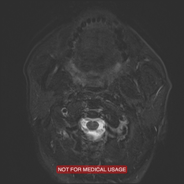Cervical nerve schwannoma (Radiopaedia 27964-28221 C 21).jpg