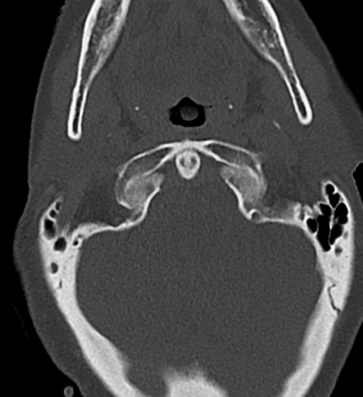 Cervical spine ACDF loosening (Radiopaedia 48998-54070 Axial bone window 12).png