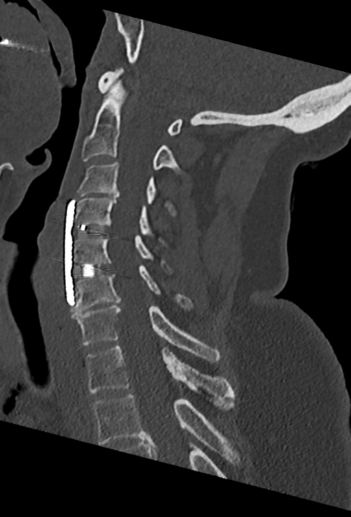 Cervical spine ACDF loosening (Radiopaedia 48998-54070 Sagittal bone window 47).png