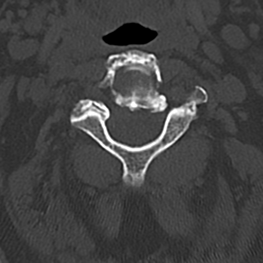 File:Cervical spine fracture - chalk stick (Radiopaedia 39116-41323 Axial bone window 27).png
