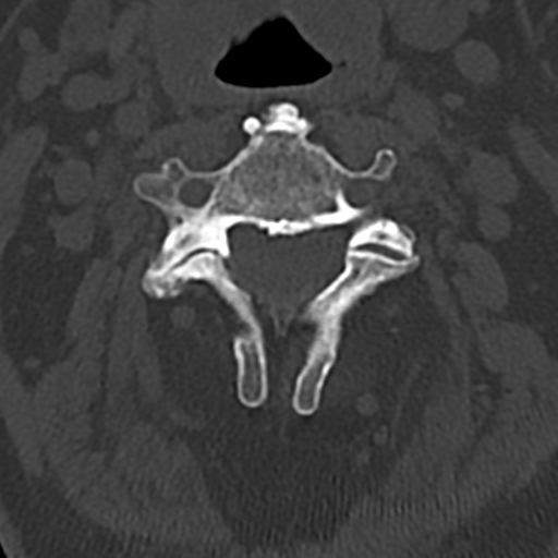 File:Cervical spine fracture - chalk stick (Radiopaedia 39116-41323 Axial bone window 31).png