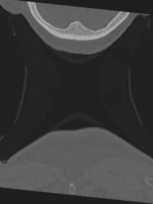 Cervical spondylolysis (Radiopaedia 49616-54811 Coronal bone window 77).png