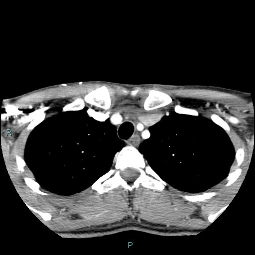 Cervical thymic cyst (Radiopaedia 88632-105335 B 16).jpg