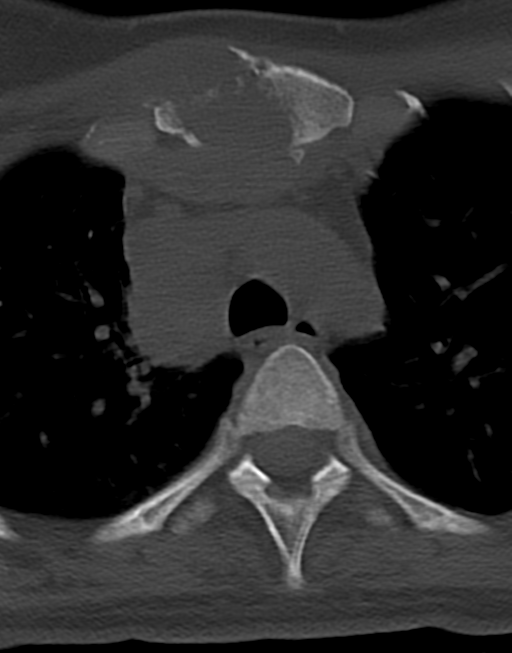 Cervical tuberculous spondylitis (Radiopaedia 39149-41365 Axial bone window 60).png