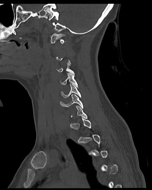 Cervical tuberculous spondylitis (Radiopaedia 39149-41365 Sagittal bone window 22).png
