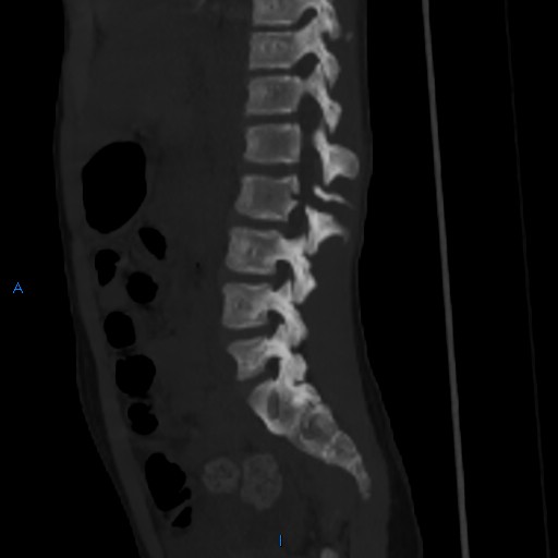 File:Chance fracture with duodenal and pancreatic lacerations (Radiopaedia 43477-50042 Sagittal bone window 7).jpg