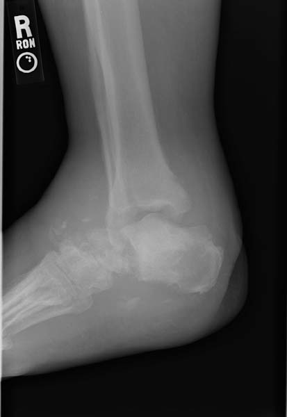 File:Charcot joint (Radiopaedia 11294-11658 Lateral 1).jpg