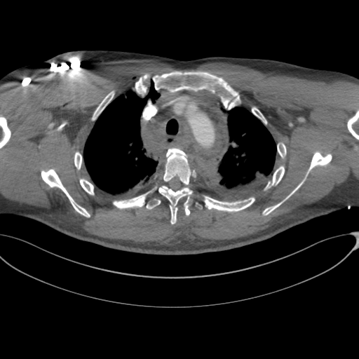 File:Chest multitrauma - aortic injury (Radiopaedia 34708-36147 A 74).png