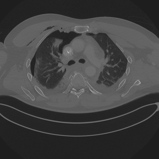Chest multitrauma - aortic injury (Radiopaedia 34708-36147 Axial bone window 120).png