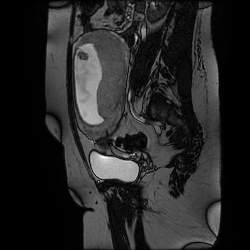 Chiari II malformation - fetal MRI (Radiopaedia 68099-77581 Sagittal Fiesta 38).jpg