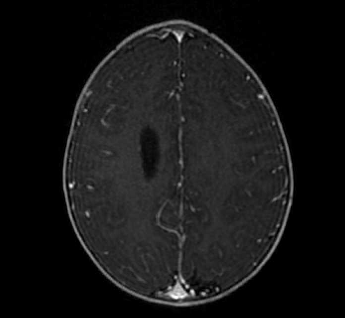 Chiasmatic-hypothalamic glioma (Radiopaedia 90079-107252 Axial T1 C+ 65).jpg