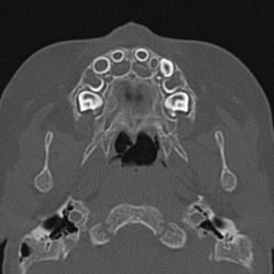 Choanal atresia (Radiopaedia 88525-105975 Axial bone window 10).jpg