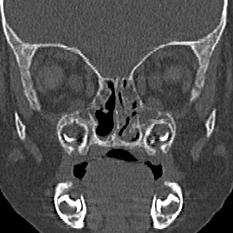 Choanal atresia (Radiopaedia 88525-105975 Coronal bone window 48).jpg