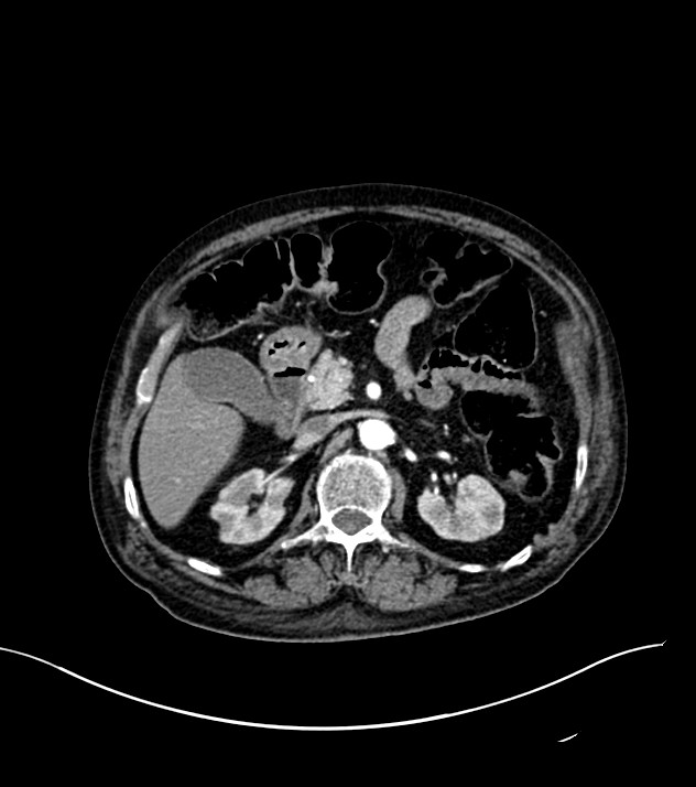 Cholangiocarcinoma with cerebral metastases (Radiopaedia 83519-98629 B 35).jpg