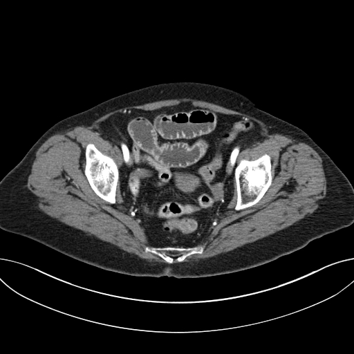 Cholecystoduodenal fistula due to calculous cholecystitis with gallstone migration (Radiopaedia 86875-103077 A 64).jpg