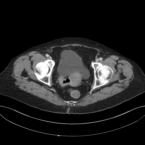 Cholecystoduodenal fistula due to calculous cholecystitis with gallstone migration (Radiopaedia 86875-103077 D 74).jpg
