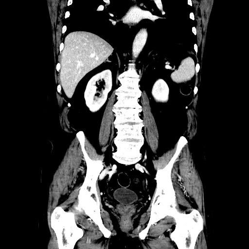 Choledocholiathiasis with normal caliber common bile duct (Radiopaedia 75368-86632 Coronal liver window 82).jpg