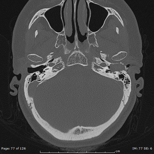 Cholesteatoma - external auditory canal (Radiopaedia 88452-105096 Axial bone window 40).jpg