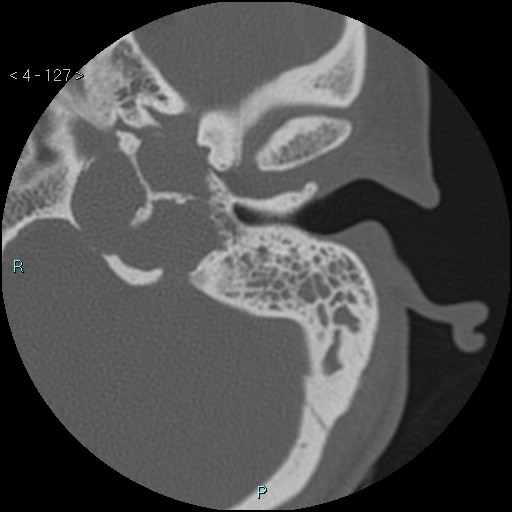 File:Cholesterol granuloma of the petrous apex (Radiopaedia 64358-73141 Axial bone window 61).jpg