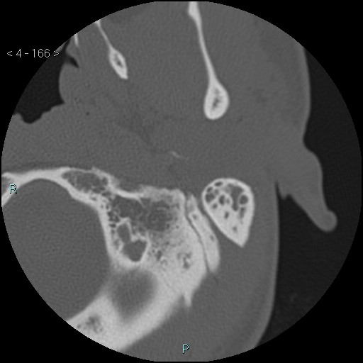 File:Cholesterol granuloma of the petrous apex (Radiopaedia 64358-73141 Axial bone window 80).jpg