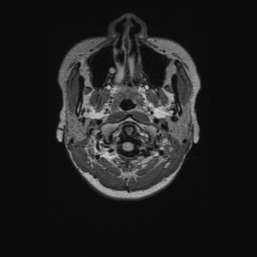 Chondrosarcoma (Radiopaedia 41937-44939 Axial FLAIR 1).png