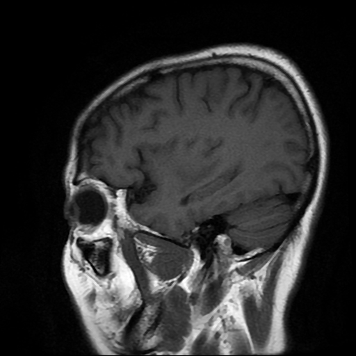 File:Chordoid glioma of third ventricle (Radiopaedia 91612-109340 Sagittal T1 5).jpg