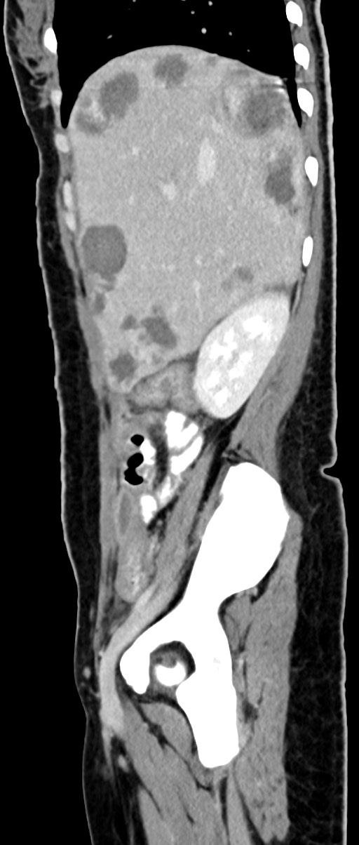 Choriocarcinoma liver metastases (Radiopaedia 74768-85766 C 128).jpg