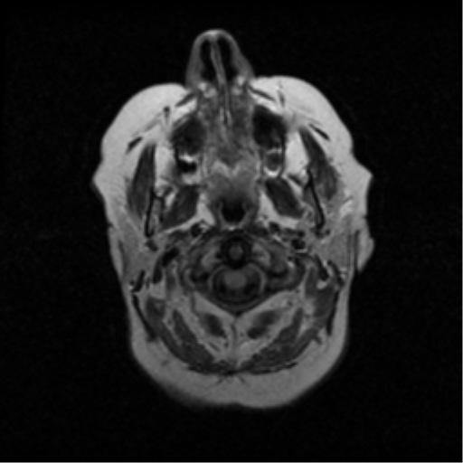 File:Choroid plexus papilloma (Radiopaedia 33040-34052 Axial FLAIR 2).png
