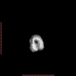 Choroid plexus xanthogranuloma (Radiopaedia 67843-77270 Axial T1 12).jpg