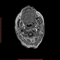 Choroid plexus xanthogranuloma (Radiopaedia 67843-77270 Axial T1 169).jpg