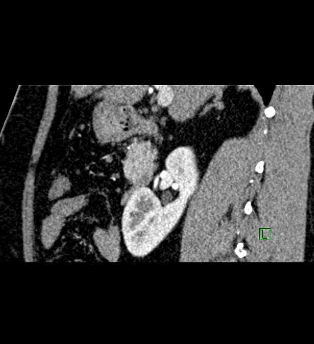 Chromophobe renal cell carcinoma (Radiopaedia 84286-99573 F 105).jpg