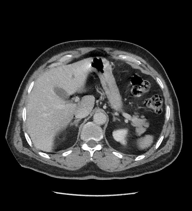Chromophobe renal cell carcinoma (Radiopaedia 86879-103083 C 33).jpg