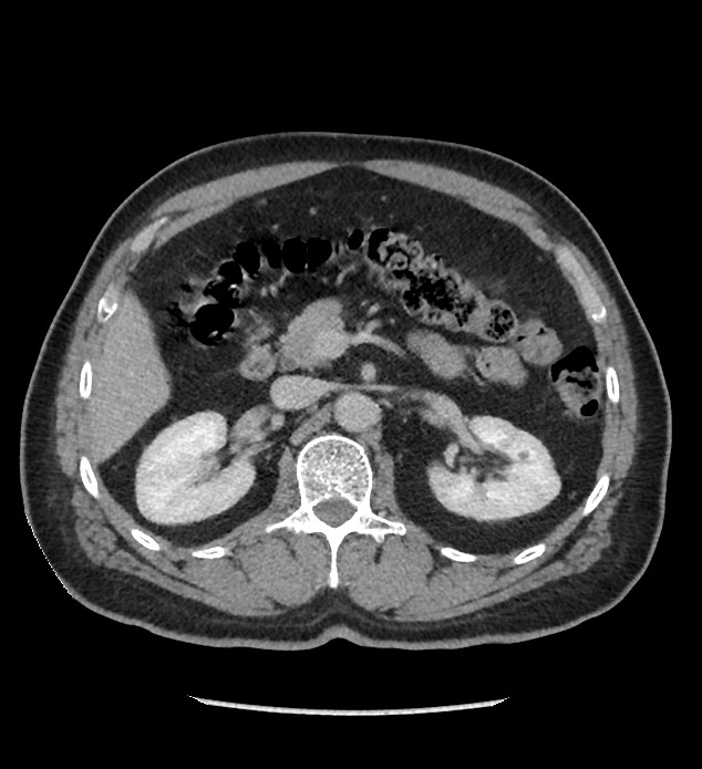 Chromophobe renal cell carcinoma (Radiopaedia 86879-103083 C 52).jpg