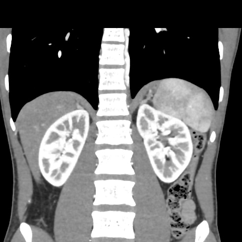 File:Chronic calcific pancreatitis (Radiopaedia 56280-62953 E 23).jpg