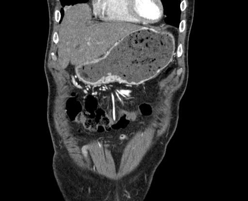 File:Chronic contained rupture of abdominal aortic aneurysm with extensive erosion of the vertebral bodies (Radiopaedia 55450-61901 D 3).jpg