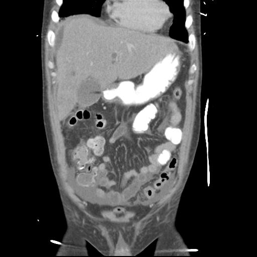 Chronic diverticulitis complicated by hepatic abscess and portal vein thrombosis (Radiopaedia 30301-30938 B 19).jpg