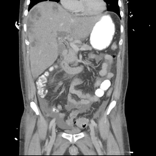 Chronic diverticulitis complicated by hepatic abscess and portal vein thrombosis (Radiopaedia 30301-30938 B 26).jpg