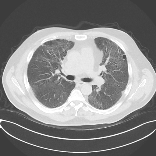 Chronic hypersensitivity pneumonitis (Radiopaedia 48107-52922 Axial lung window 29).png