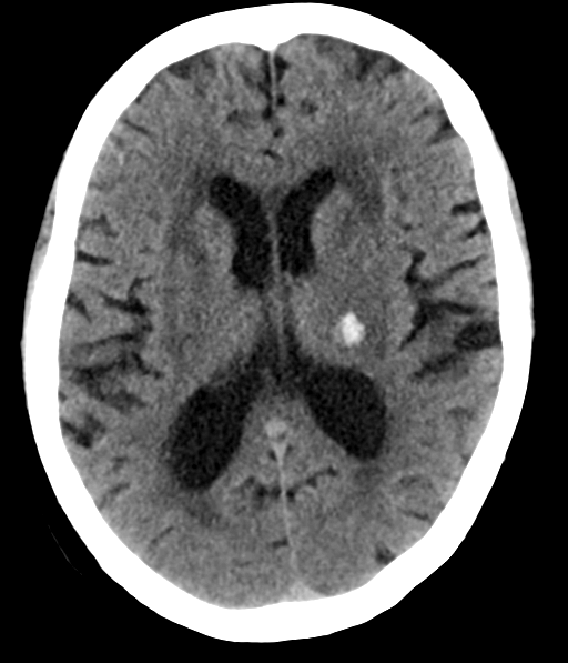 File:Chronic hypertensive encephalopathy (Radiopaedia 39993-42485 Axial non-contrast 19).png