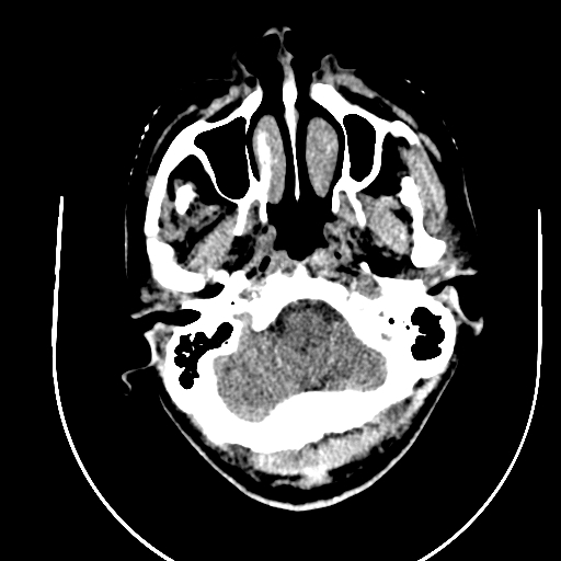 File:Chronic invasive fungal sinusitis (Radiopaedia 91563-109286 Axial non-contrast 3).jpg