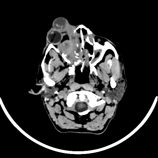 File:Chronic invasive fungal sinusitis with intraorbital and intracranial extension (Radiopaedia 56387-63046 Axial non-contrast 81).jpg