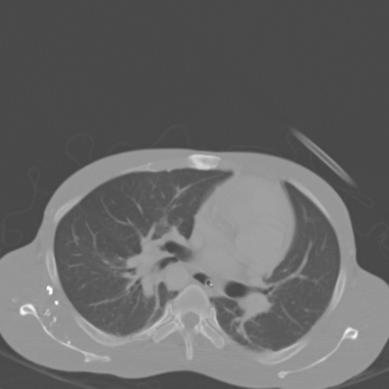 Chronic large bowel pseudo-obstruction (Radiopaedia 43181-46492 Axial bone window 10).jpg