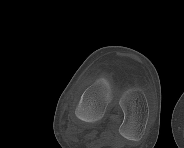 Chronic ostemyelitis of the femur with long sinus tract (Radiopaedia 74947-85982 Axial bone window 225).jpg