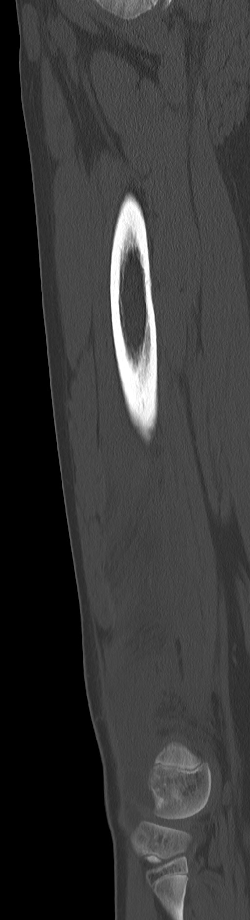 Chronic ostemyelitis of the femur with long sinus tract (Radiopaedia 74947-85982 Sagittal bone window 40).jpg