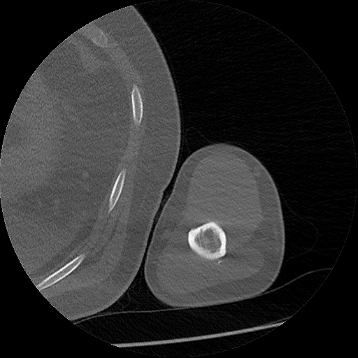 Chronic osteomyelitis (Radiopaedia 67597-76998 Axial bone window 45).jpg
