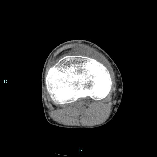 Chronic osteomyelitis (with Brodie abscess) (Radiopaedia 76405-88111 A 101).jpg