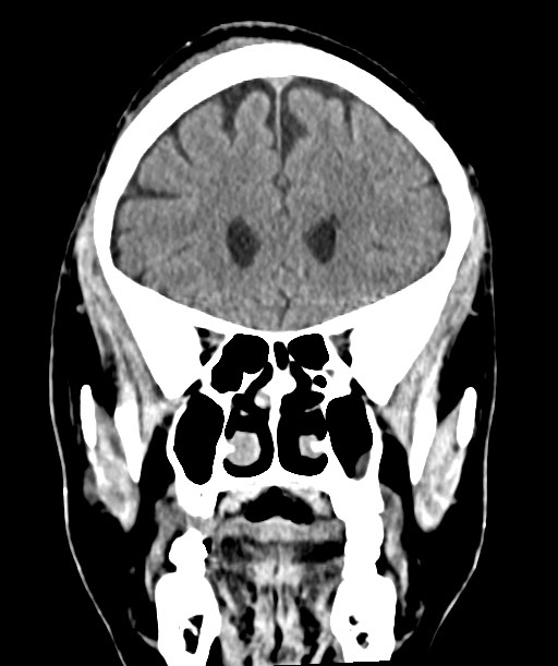 Chronic osteomyelitis - calvarial (severe) (Radiopaedia 69668-79616 Coronal non-contrast 24).jpg