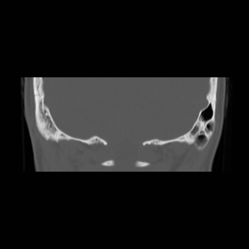 File:Chronic otomastoiditis (Radiopaedia 27138-27309 Coronal bone window 25).jpg