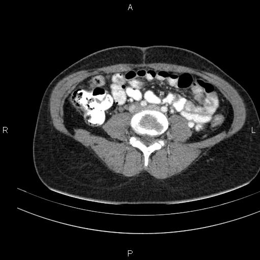 File:Chronic pancreatitis (Radiopaedia 64576-73450 B 103).jpg
