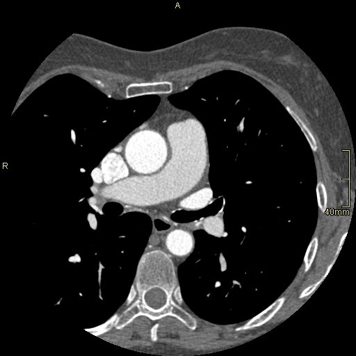Chronic pulmonary embolism (Radiopaedia 73073-85094 Axial C+ CTPA 66).jpg